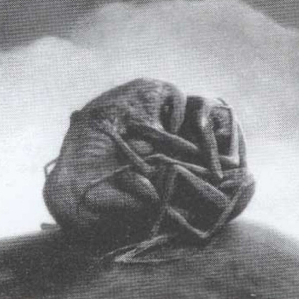 Primary Amebic Meningoencephalitis - Untiltled