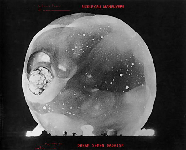 Sickle Cell Maneuvers - Alternate