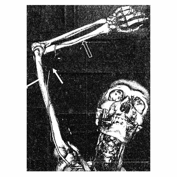 Torturewave - Pubic Lice