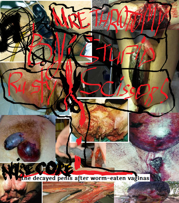 Urethrotomy By Stupid Rusty Scissors - The Dry Gangrene of Fingers of the Left Foot Which Developed at Obliterating Atherosclerosis Against the Background of a Diabetes Mellitus
