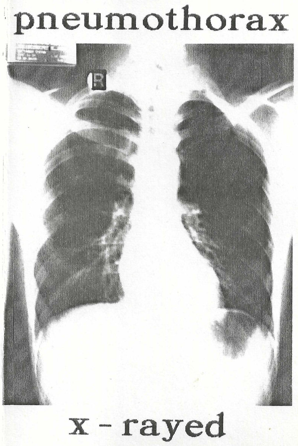 pneumothorax - Ekidna Overdrive